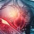 Bagaimana Cara Membaca Syntax Scoring Penyakit Jantung?