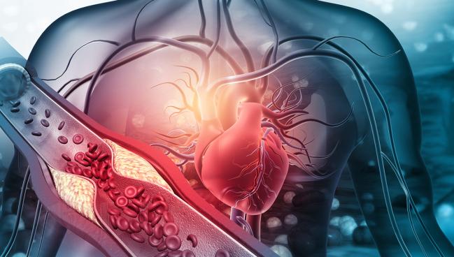 Bagaimana Cara Membaca Syntax Scoring Penyakit Jantung?